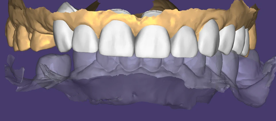 3D design of an upper anterior restoration shown in the online viewer