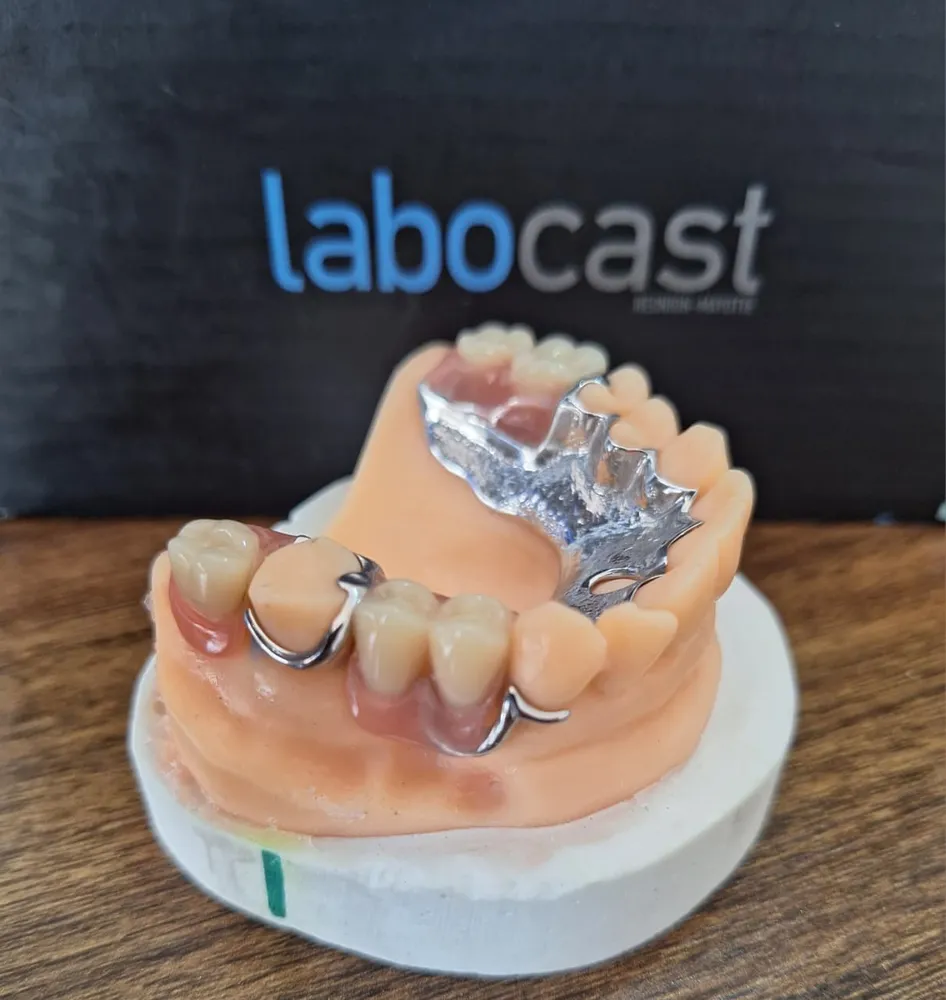 Cobalt-chromium partial denture on a model