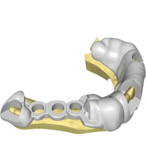 Digital Surgical Guides